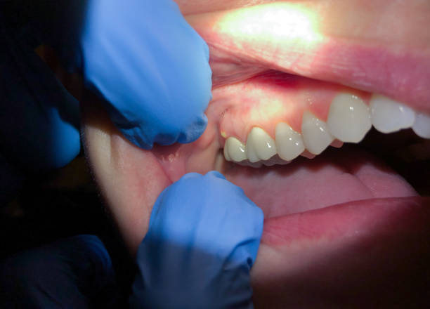 Best Emergency Treatment for Toothache in Morganton, NC