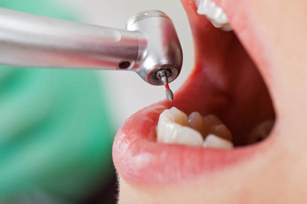 Best Emergency Root Canal Treatment in Morganton, NC
